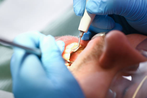 Best Emergency Wisdom Tooth Extraction in Lumbine, CO